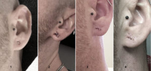 Inkery Ohrläppchen Rekonstruktion earlobe reconstruction Leipzig